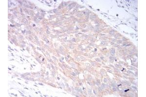 Immunohistochemical analysis of paraffin-embedded esophageal cancer tissues using LRP1 mouse mAb with DAB staining. (LRP1 anticorps  (AA 20-155))