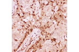 Anti-RUNX1/AML1 Picoband antibody ,  IHC(P): Human Mammary Cancer Tissue (RUNX1 anticorps  (Middle Region))