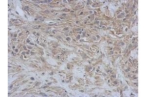 IHC-P Image Immunohistochemical analysis of paraffin-embedded U373 xenograft, using RAP1GDS1, antibody at 1:500 dilution.