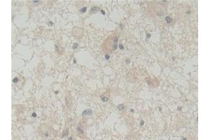 Detection of ABI1 in Human Glioma Tissue using Polyclonal Antibody to Abl Interactor 1 (ABI1)
