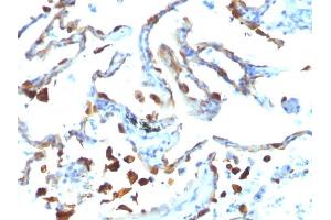 Formalin-fixed, paraffin-embedded human Lung Carcinoma stained with Milk Fat Globule Monoclonal Antibody (MFG-06) (MFGE8 anticorps)