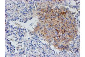 Immunohistochemical staining of paraffin-embedded Carcinoma of Human lung tissue using anti-RFXANK mouse monoclonal antibody. (RFXANK anticorps)