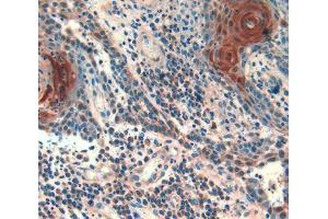 IHC-P analysis of skin cancer tissue, with DAB staining. (Follistatin anticorps  (AA 35-283))