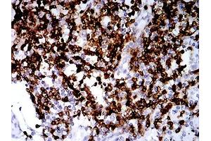 Immunohistochemical analysis of paraffin-embedded lung cancer tissues using CD2 mouse mAb with DAB staining. (CD2 anticorps  (AA 25-140))