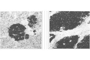 Left and Center: Immunohistochemical staining of normal pancreas tissue (left) and small bowel tumor tissue (center) using NSE antibody (X2070M and X2071M). (ENO2/NSE anticorps)