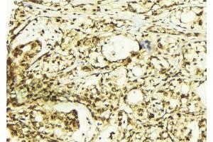 ABIN6267408 at 1/100 staining Human breast cancer tissue by IHC-P.