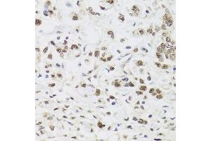 Immunohistochemistry of paraffin-embedded human gastric cancer using PPP1CC antibody at dilution of 1:100 (x40 lens).