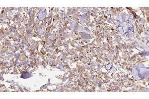 ABIN6276935 at 1/100 staining Human Melanoma tissue by IHC-P. (IL-24 anticorps  (Internal Region))