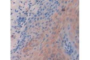 IHC-P analysis of Human Tissue, with DAB staining. (KRT14 anticorps  (AA 111-418))