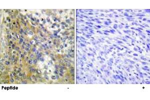 Immunohistochemistry analysis of paraffin-embedded human cervix carcinoma tissue using COL4A6 polyclonal antibody . (COL4a6 anticorps)