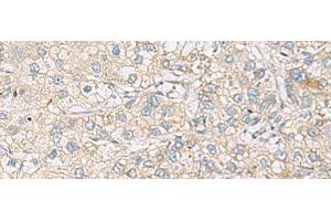 Immunohistochemistry of paraffin-embedded Human liver cancer tissue using RAC2 Polyclonal Antibody at dilution of 1:60(x200)