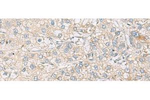 Immunohistochemistry of paraffin-embedded Human liver cancer tissue using RAC2 Polyclonal Antibody at dilution of 1:60(x200) (RAC2 anticorps)