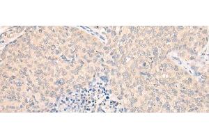 Immunohistochemistry of paraffin-embedded Human cervical cancer tissue using SEPT10 Polyclonal Antibody at dilution of 1:25(x200)