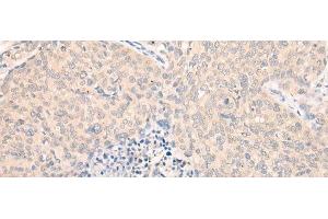 Immunohistochemistry of paraffin-embedded Human cervical cancer tissue using SEPT10 Polyclonal Antibody at dilution of 1:25(x200) (Septin 10 anticorps)