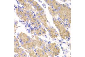 Immunohistochemistry of paraffin-embedded human gastric cancer using SMYD4 antibody. (SMYD4 anticorps  (AA 1-260))