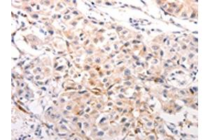 The image on the left is immunohistochemistry of paraffin-embedded Human breast cancer tissue using ABIN7191245(KRT6A/KRT6B/KRT6C/KRT6B/KRT6C Antibody) at dilution 1/40, on the right is treated with synthetic peptide. (KRT6A anticorps)