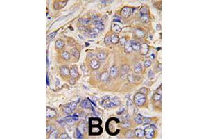 Formalin-fixed and paraffin-embedded human breast carcinoma tissue reacted with HSPB1 polyclonal antibody  , which was peroxidase-conjugated to the secondary antibody, followed by DAB staining. (HSP27 anticorps  (Ser78))