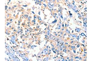 The image on the left is immunohistochemistry of paraffin-embedded Human esophagus cancer tissue using ABIN7129275(DUSP14 Antibody) at dilution 1/20, on the right is treated with fusion protein. (DUSP14 anticorps)