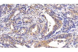 Detection of CNN1 in Human Stomach cancer Tissue using Polyclonal Antibody to Calponin 1, Basic (CNN1) (CNN1 anticorps  (AA 1-268))