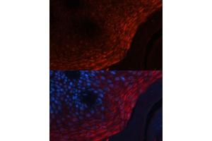 Immunofluorescence analysis of human skin cancer using S100 Polyclonal Antibody (ABIN7270129) at dilution of 1:100 (40x lens).