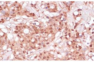 Immunohistochemistry of paraffin-embedded Human breast cancer using BYSL Polyclonal Antibody at dilution of 1:100 (40x lens). (Bystin-Like anticorps)