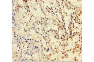Immunohistochemistry of paraffin-embedded human lung cancer using ABIN7149900 at dilution of 1:100 (Dihydrofolate Reductase anticorps  (AA 2-187))