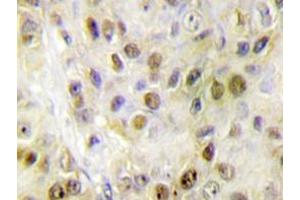 Immunohistochemistry analyzes of RORα antibody in paraffin-embedded human breast carcinoma tissue. (RORA anticorps)