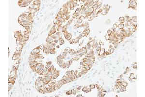 IHC-P Image Immunohistochemical analysis of paraffin-embedded human ovarian cancer, using Adenylate cyclase 2, antibody at 1:250 dilution.