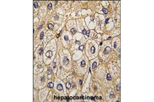 Formalin-fixed and paraffin-embedded human hepatocarcinoma tissue reacted with EphA7 antibody , which was peroxidase-conjugated to the secondary antibody, followed by DAB staining. (EPH Receptor A7 anticorps)