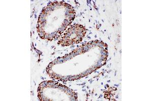 Anti-MTCO1 antibody, IHC(P): Human Mammary Cancer Tissue (COX1 anticorps  (C-Term))