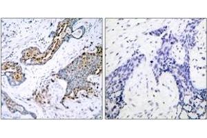 Immunohistochemistry analysis of paraffin-embedded human breast carcinoma, using Estrogen Receptor-alpha (Phospho-Ser118) Antibody.