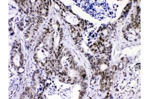 IHC testing of FFPE human intestinal cancer with hnRNP F antibody at 1ug/ml.