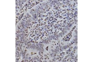 Immunohistochemistry of paraffin-embedded human colon carcinoma using MonoMethyl-Histone H3-K9 antibody (ABIN7267685) at dilution of 1:100 (40x lens). (Histone 3 anticorps  (H3K9me))