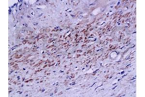Formalin-fixed and paraffin embedded human prostate labeled with Rabbit Anti phospho-Androgen Receptor(Ser578) Polyclonal Antibody, Unconjugated (ABIN730123) at 1:200 followed by conjugation to the secondary antibody and DAB staining (Androgen Receptor anticorps  (pSer578))