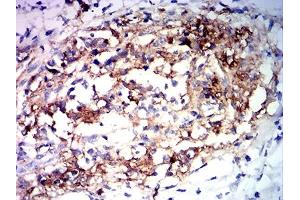 Immunohistochemical analysis of paraffin-embedded stomach cancer tissues using MUC2 mouse mAb with DAB staining.
