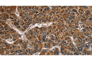 Immunohistochemistry of paraffin-embedded Human liver cancer using CAT Polyclonal Antibody at dilution of 1:40 (Catalase anticorps)