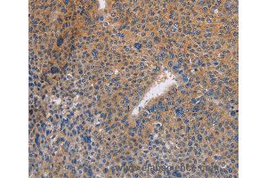 Immunohistochemistry of Human cervical cancer using NEK8 Polyclonal Antibody at dilution of 1:30