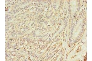 Immunohistochemistry of paraffin-embedded human breast cancer using ABIN7144179 at dilution of 1:100 (ASB11 anticorps  (AA 41-315))