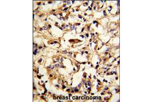 Formalin-fixed and paraffin-embedded human breast carcinoma reacted with DFNA5 Antibody (N-term), which was peroxidase-conjugated to the secondary antibody, followed by DAB staining.