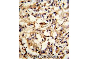 Formalin-fixed and paraffin-embedded human breast carcinoma reacted with DFNA5 Antibody (N-term), which was peroxidase-conjugated to the secondary antibody, followed by DAB staining. (DFNA5 anticorps  (N-Term))