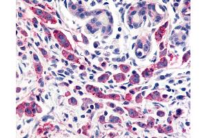 Anti-ELTD1 antibody IHC of human Breast, Carcinoma. (ELTD1 anticorps  (N-Term))