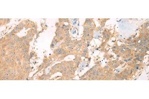 Immunohistochemistry of paraffin-embedded Human colorectal cancer tissue using ASIC3 Polyclonal Antibody at dilution of 1:40(x200) (ASIC3 anticorps)