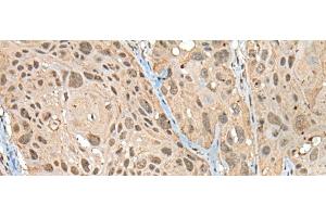 Immunohistochemistry of paraffin-embedded Human esophagus cancer tissue using ZNF468 Polyclonal Antibody at dilution of 1:30(x200) (ZNF468 anticorps)