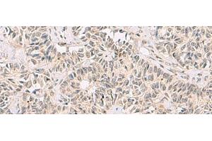 Immunohistochemistry of paraffin-embedded Human ovarian cancer tissue using RNF13 Polyclonal Antibody at dilution of 1:60(x200)