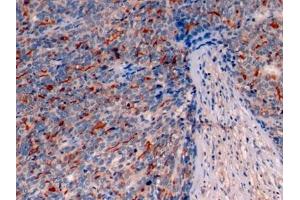 Detection of MUC1 in Human Ovarian cancer Tissue using Polyclonal Antibody to Mucin 1 (MUC1)