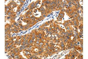 The image on the left is immunohistochemistry of paraffin-embedded Human ovarian cancer tissue using ABIN7192878(TRAF3 Antibody) at dilution 1/40, on the right is treated with synthetic peptide. (TRAF3 anticorps)