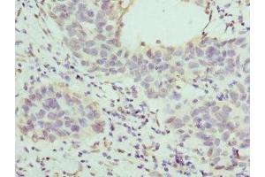 Immunohistochemistry of paraffin-embedded human bladder cancer using ABIN7155947 at dilution of 1:100
