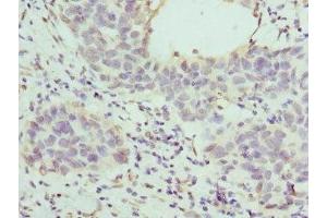 Immunohistochemistry of paraffin-embedded human bladder cancer using ABIN7155947 at dilution of 1:100 (HAPLN1 anticorps  (AA 165-354))