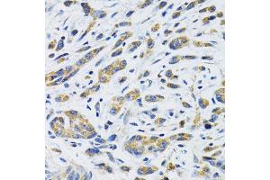 Immunohistochemistry of paraffin-embedded human gastric cancer using SLC16A4 antibody. (SLC16A4 anticorps)