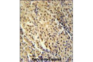 immunohistochemistry analysis in formalin fixed and paraffin embedded human cervix carcinoma followed by peroxidase conjugation of the secondary antibody and DAB staining.